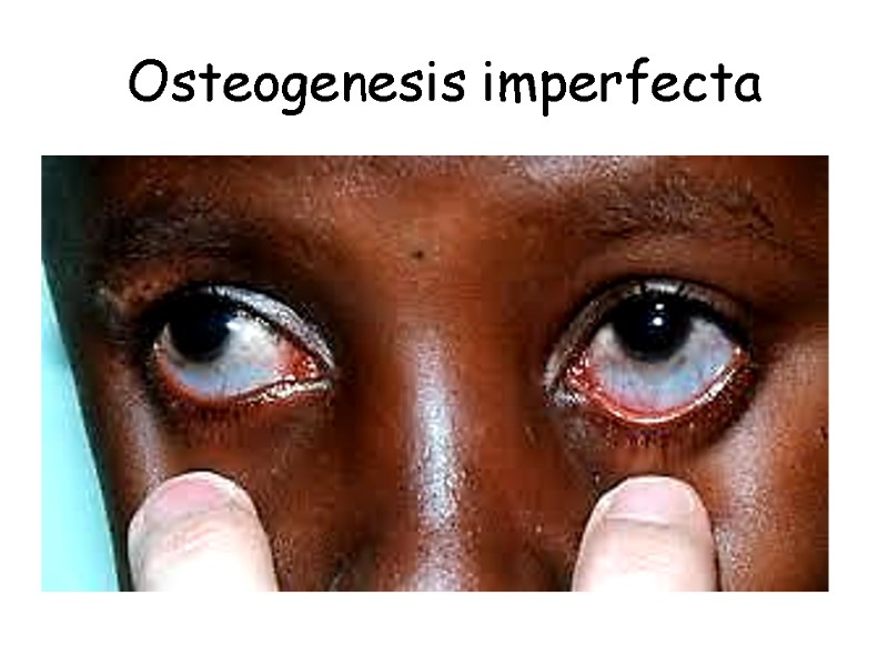 Osteogenesis imperfecta